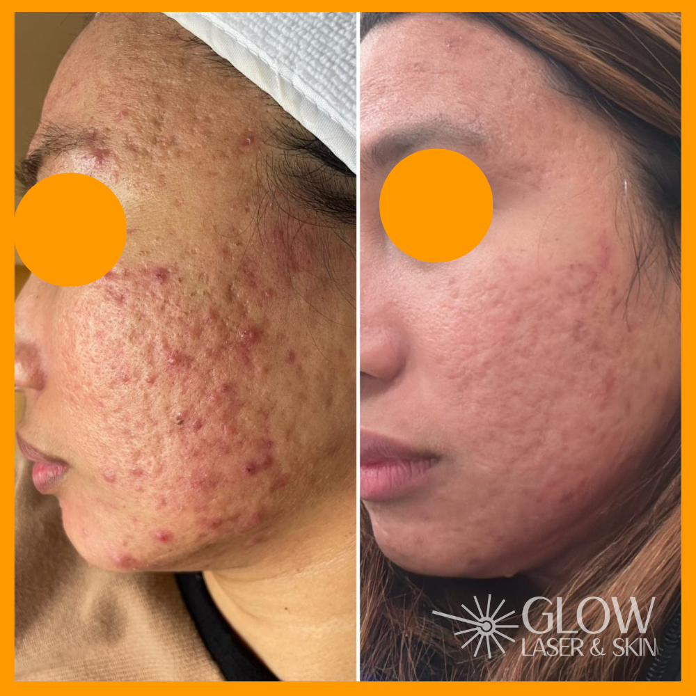 Glow Laser Skin Inc. Calgary In Calgary CA AB Vagaro