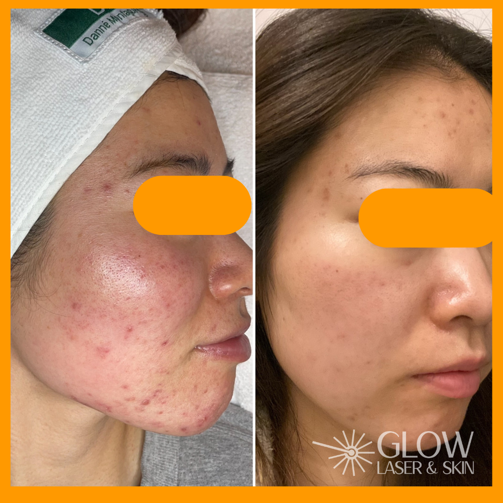 Glow Laser Skin Inc. Calgary In Calgary CA AB Vagaro